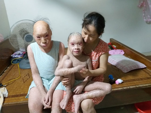 Sẻ chia nỗi buồn cùng hai em bị bệnh da khô vảy cá