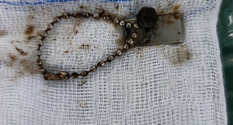 Mổ cấp cứu cho bé trai thủng ruột do nuốt nam châm