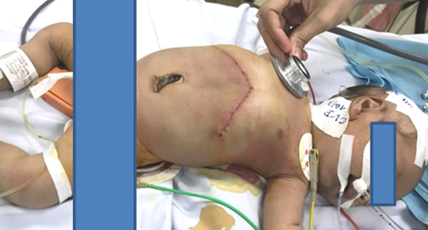 Cắt toàn bộ lá gan bên trái bị u cho trẻ sơ sinh
