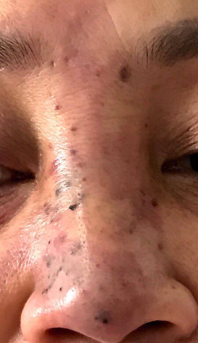 Biến dạng, mưng mủ khuôn mặt sau tiêm chất làm đầy ở Spa