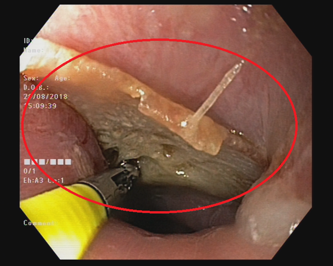 Hóc xương cá đúng lúc quả bóng  "vàng" của U23 Việt Nam sút tung lưới U23 Syria