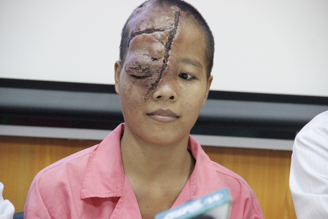 Giải thoát khối bướu máu "khủng" trên mặt cho cô gái 21 tuổi