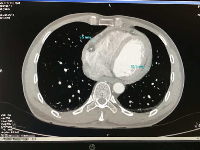 Màng tim xơ như 'mo cau' suýt lấy mạng người đàn ông