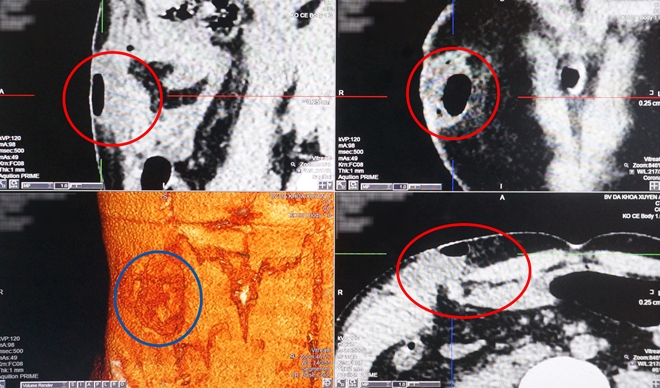 Kỳ tích cứu sống người bị tai nạn giao thông vỡ nát nhiều bộ phận cơ thể