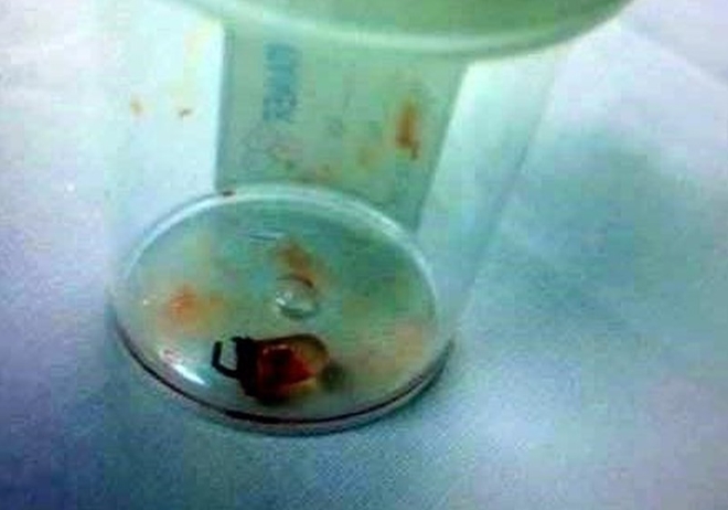 (Hy hữu) Bóng đèn led nằm hơn 1 năm trong phổi một bé trai