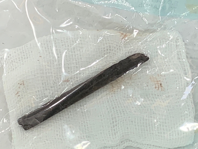 Khúc đũa 7 cm bị "bỏ quên" trong hốc mũi bệnh nhân suốt 4 năm