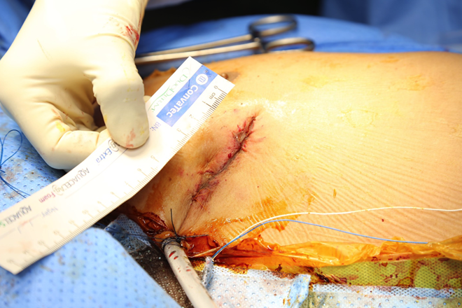 Bệnh viện cấp quận đầu tiên thực hiện được phẫu thuật tim hở ít xâm lấn