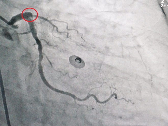Suýt đột tử vì tự ý dùng thuốc trị đau ngực