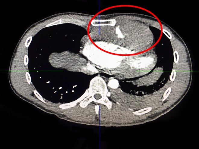 Giữ mạng sống cho nam thanh niên dùng dao tự đâm thấu ngực