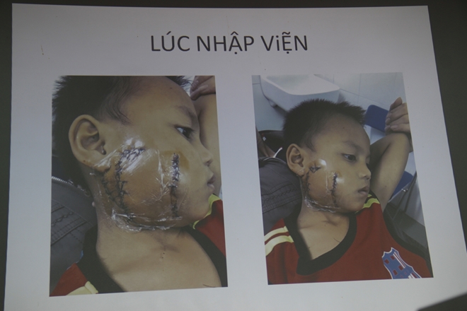 Lấy lại khuôn mặt cho bệnh nhi bị cánh quạt công nghiệp "chém nát"