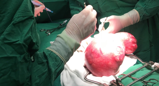 Cô gái 22 tuổi, phát hiện mang khối u nặng gần 4 ki lô gam