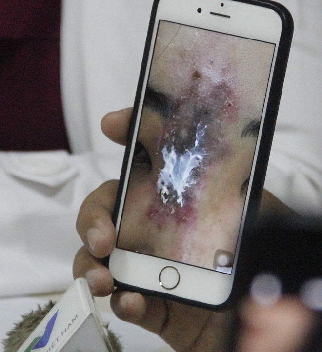 Bị hoại tử mũi vì làm đẹp tại cơ sở thẩm mỹ chui