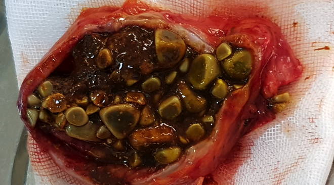 Giúp bệnh nhân Campuchia loại bỏ hàng trăm viên sỏi nằm trong túi mật 