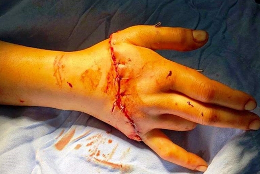  Nối thành công bàn tay đứt rời do bị cưa máy cắt