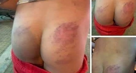 Tạm đình chỉ cô giáo đánh học sinh lớp 2 tím mông