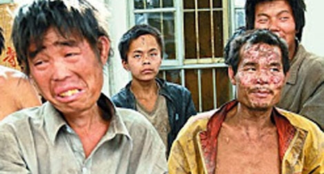 Nhiễm độc chì – Kẻ giết người thầm lặng