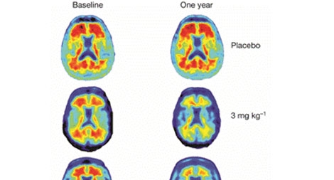 Thuốc mới Aducanumab hứa hẹn chữa khỏi bệnh Alzheimer