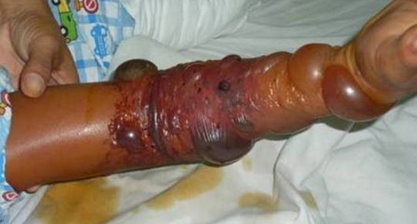 Khi bị rắn độc cắn…