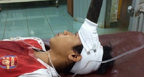 Cứu sống bé trai 12 tuổi bị dao đâm giữa trán