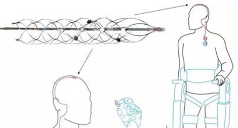 Cột sống nhân tạo giúp người bị tổn thương tủy sống phục hồi khả năng vận động