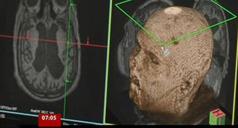 Tỉnh táo trong trạng thái sống thực vật