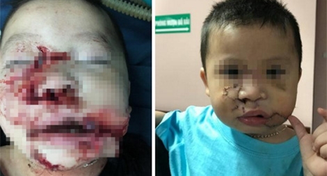 Tạo hình cho bé trai bị chó cắn nát mặt