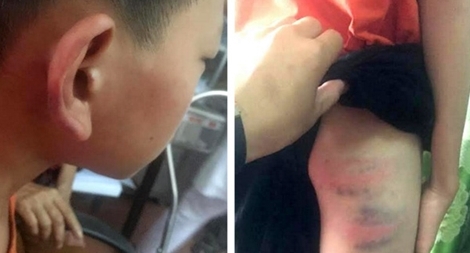 Mẹ kế bạo hành khiến một học sinh lớp 6… nhập viện cấp cứu (?)