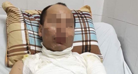 Con gái 9 tuổi hoảng loạn khi chứng kiến bố bị tạt axit