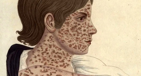 Bệnh sởi – Không thể coi thường