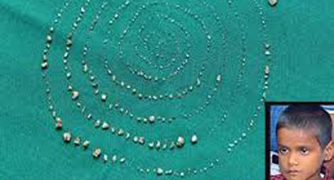 Người có nhiều răng thừa nhất thế giới