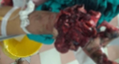 Tự chế pháo theo Youtube, thiếu niên 15 tuổi phải cắt cụt bàn tay