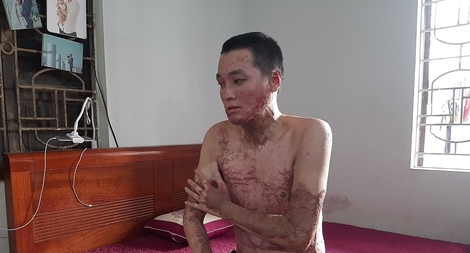 Gặp lại người đàn ông bị đồng nghiệp tẩm xăng đốt