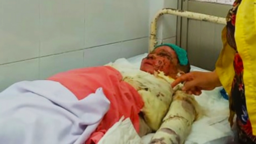 Người phụ nữ bị tình nhân đơn phương tạt acid đã tử vong