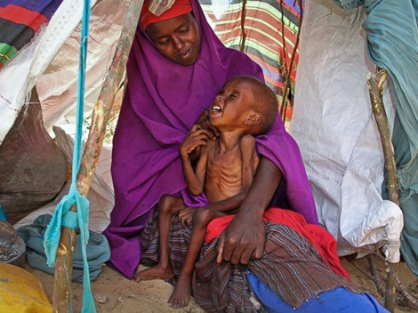 Đau xót 1,4 triệu trẻ em suy dinh dưỡng tại Somalia