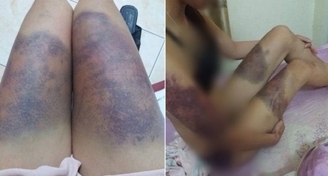 Điều tra việc cô gái tố bị người yêu hành hung dã man