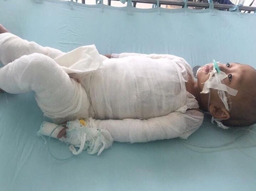 Hãy giúp đỡ cháu bé 18 tháng tuổi bị bỏng 80% cơ thể