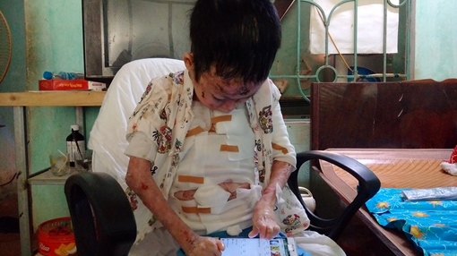 Xót xa gia cảnh của cậu bé 11 tuổi  bị "ăn mòn" cơ thể