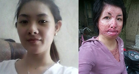 Xót xa gia cảnh người phụ nữ bị chồng tẩm xăng đốt