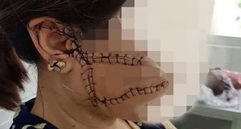 Ghen tuông, chồng rạch mặt, cắt gân chân vợ