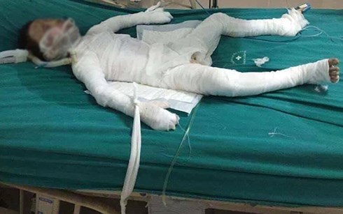 Bé trai 6 tuổi bị bố dượng tẩm xăng đốt đã qua đời
