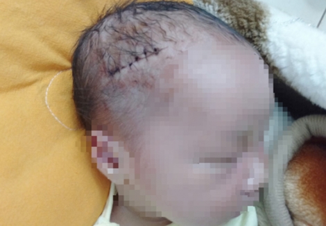 Mổ đẻ cho sản phụ, rạch trúng đầu cháu bé