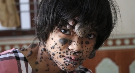 Gia cảnh thương tâm của cô bé mang trên mình hàng trăm khối u