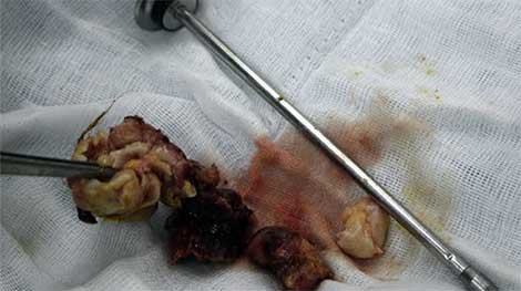 Phẫu thuật khối u dị dạng trong ngực thiếu nữ