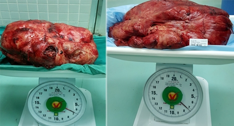Hai bệnh nhân may mắn "bứng"được khỏi ổ bụng những khối bướu "khủng"