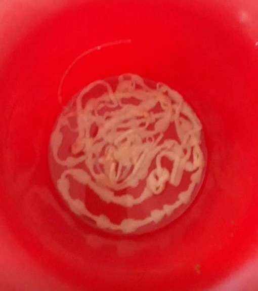 "Lôi" con sán xơ mít dài 8m sống trong cơ thể bệnh nhân