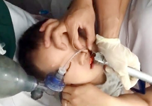 Ăn thạch rau câu, cháu bé bị hóc nguy kịch