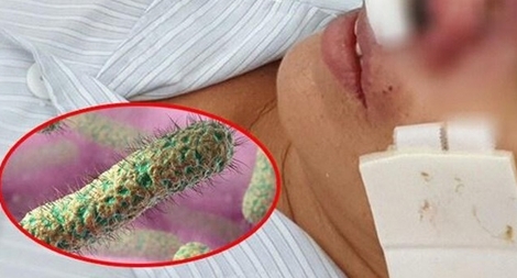 9 trường hợp ở Quảng Trị bị nhiễm vi khuẩn “ăn thịt người”