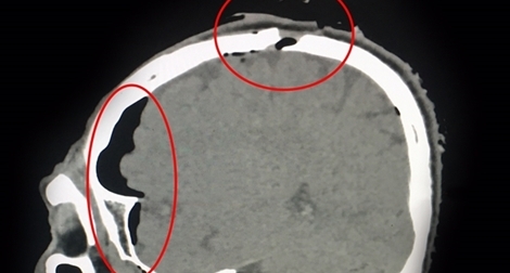 Cứu sống bệnh nhân bị chém nứt sọ