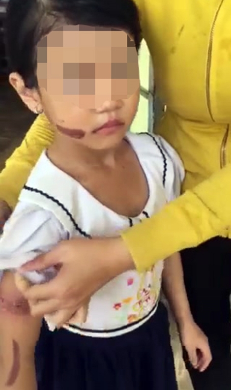 Đưa bé gái nghi bị bạo hành đi kiểm tra sức khoẻ