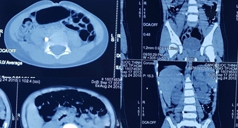 Bé trai bị đạn súng hơi của cậu xuyên thủng lưng